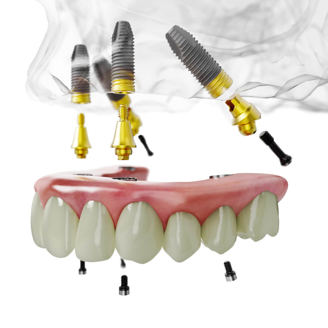 All-on-4 TiUltra Oberkiefer NobelParallel